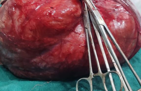 चिकित्सीय उपलब्धि के कारण एक बार फिर खासे सुर्खियों में पटना का हिमालया हॉस्पिटल,15किलोग्राम का ट्यूमर निकालकर महिला की बचाई गई है जान